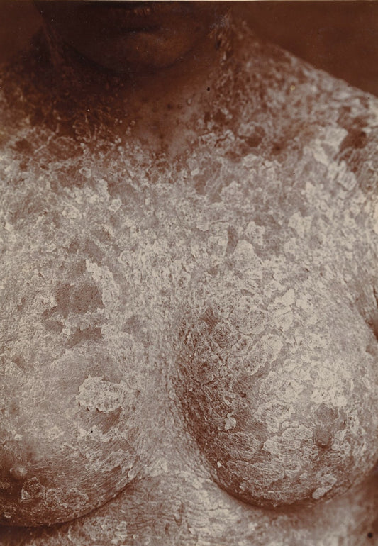Psoriasis généralisé potrine photo photographie Budin 1908 Ste Agnès maladie