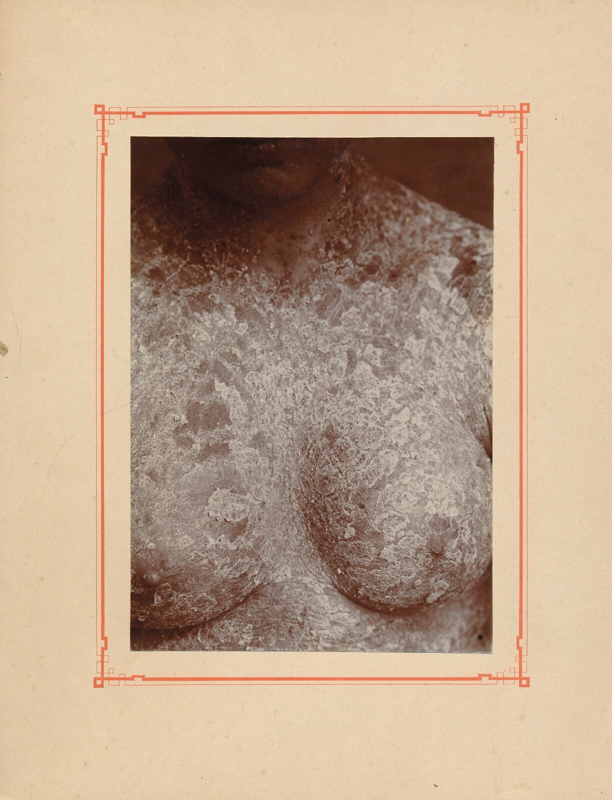 Psoriasis généralisé potrine photo photographie Budin 1908 Ste Agnès maladie
